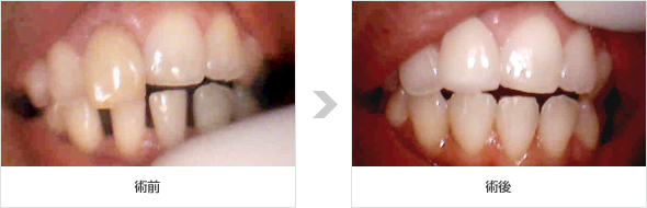 空隙歯列CR修復