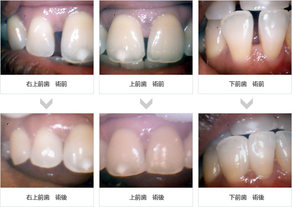 空隙歯列CR修復