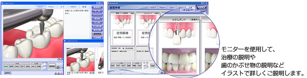 デンタルフラッシュ：モニターを使用して、治療の説明や歯のかぶせ物の説明などイラストで詳しくご説明します。