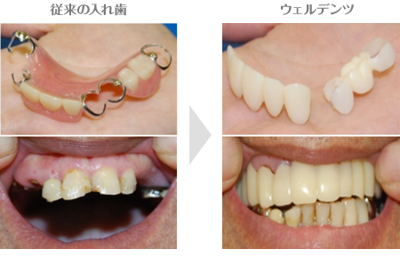 革新的な入れ歯ウェルデンツ