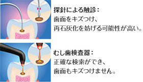 深針による触診、むし歯検査器